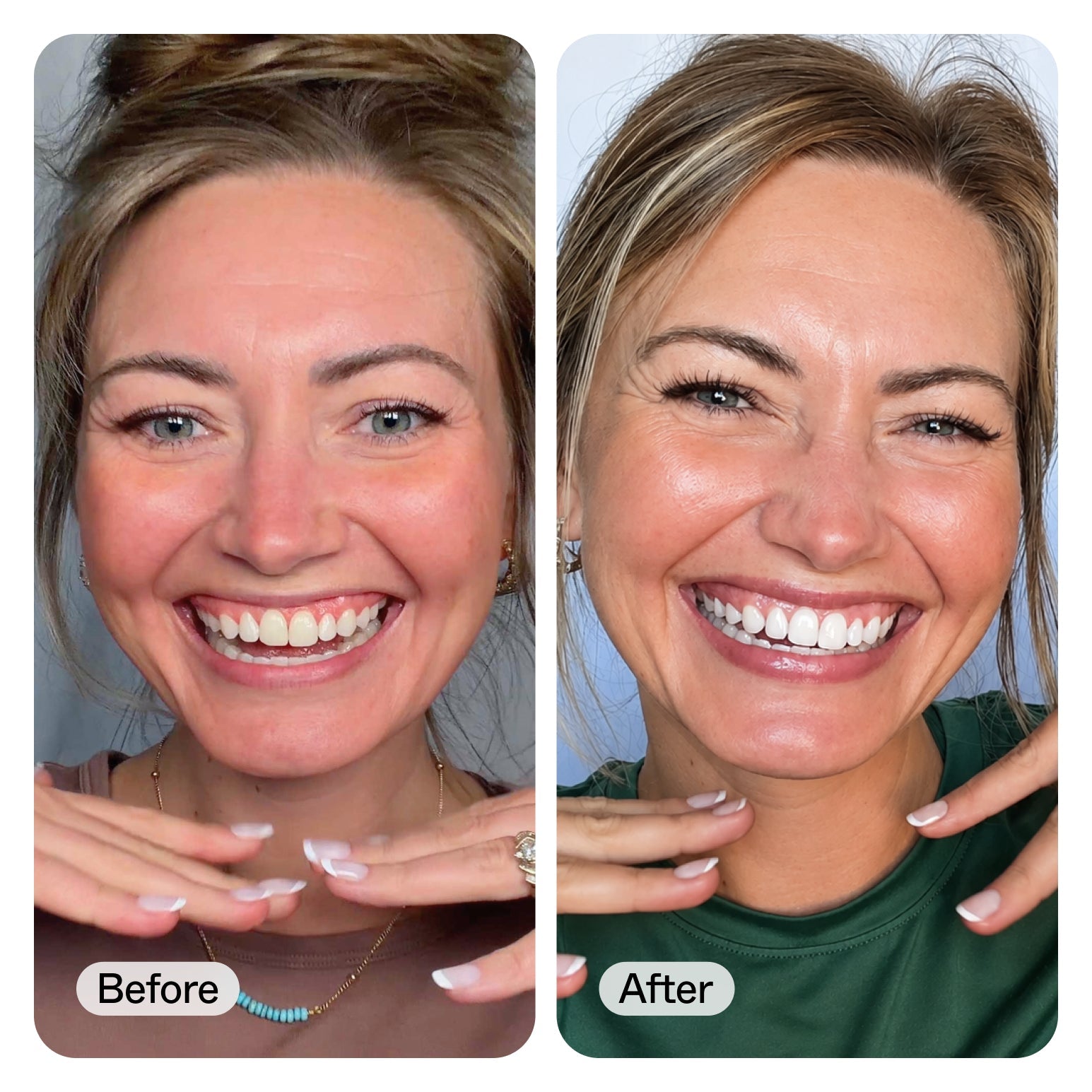 Side-by-side before and after smile close-ups of a woman, showing a dental whitening or cosmetic result. The left panel is labeled 'Before' and shows natural teeth; the right panel is labeled 'After' and shows brighter, whiter teeth.