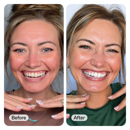 Side-by-side before and after smile close-ups of a woman, showing a dental whitening or cosmetic result. The left panel is labeled 'Before' and shows natural teeth; the right panel is labeled 'After' and shows brighter, whiter teeth.
