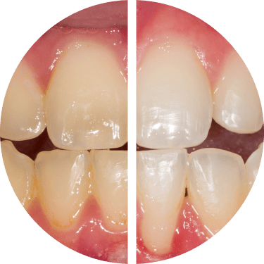 Teeth Whitening, Opalescence Treatment