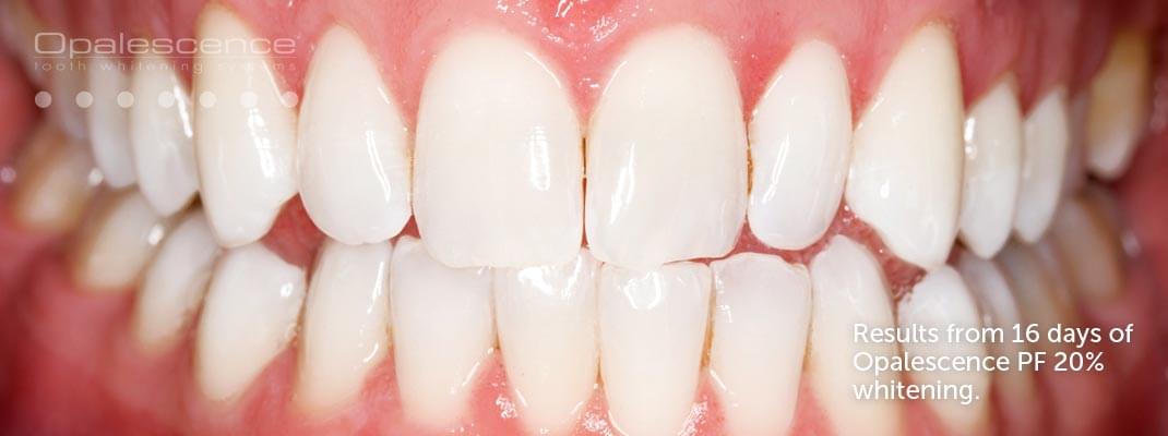 Teeth Whitening, Opalescence Treatment