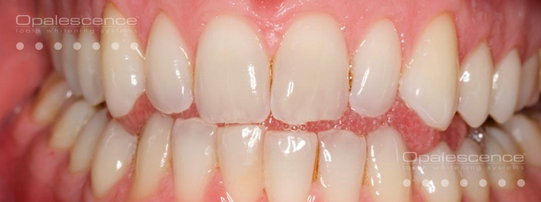 Opalescence Teeth Whitening Gel 4 Pack 35% Melon